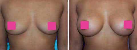 breast augmentation photos1 1