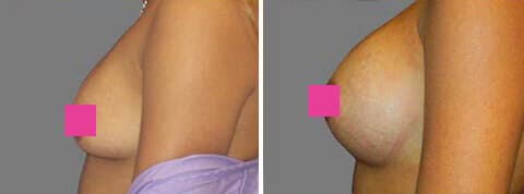 breast augmentation photos10 1