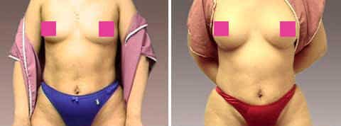 breast augmentation photos6 1