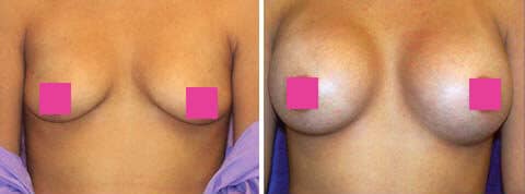 breast augmentation photos9 1
