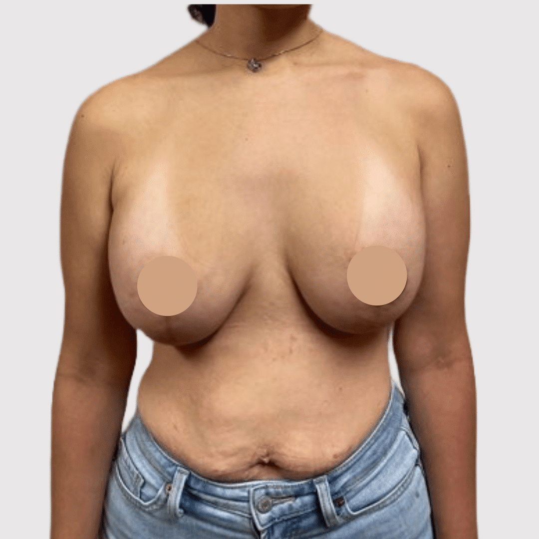 topless female patient after breast lift silicone implants