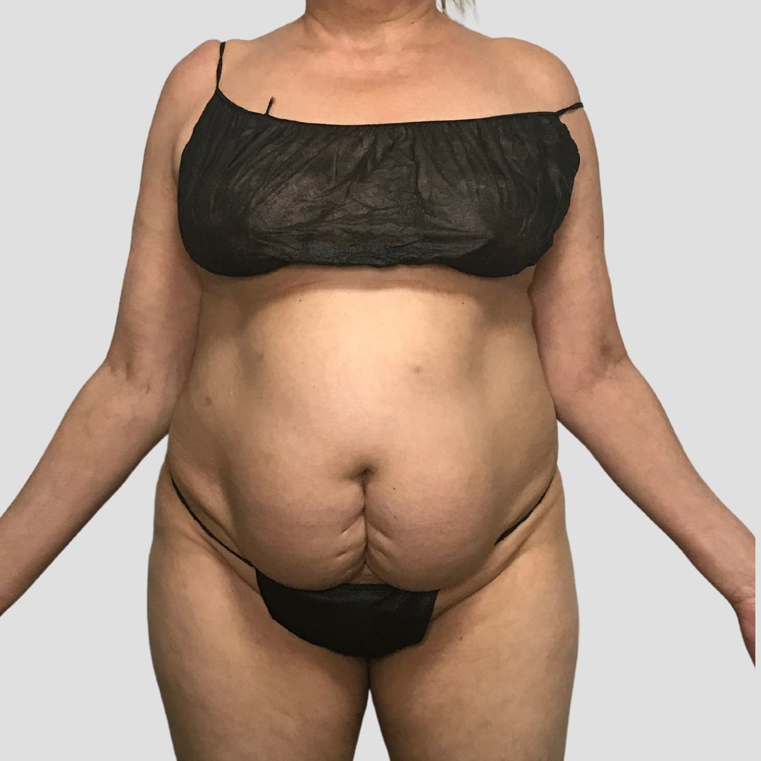 2. BEFORE Abdominoplasty Tummy Tuck Before and After SY Aesthetics