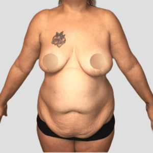 Abdominoplasty + Liposuction + Fat Transfer