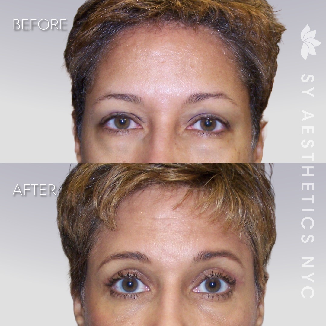 befeore and after blepharoplasty surgery in New York City