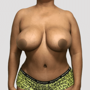 Breast Lift with Implant Removal