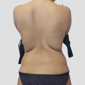 Full Liposuction of the Back