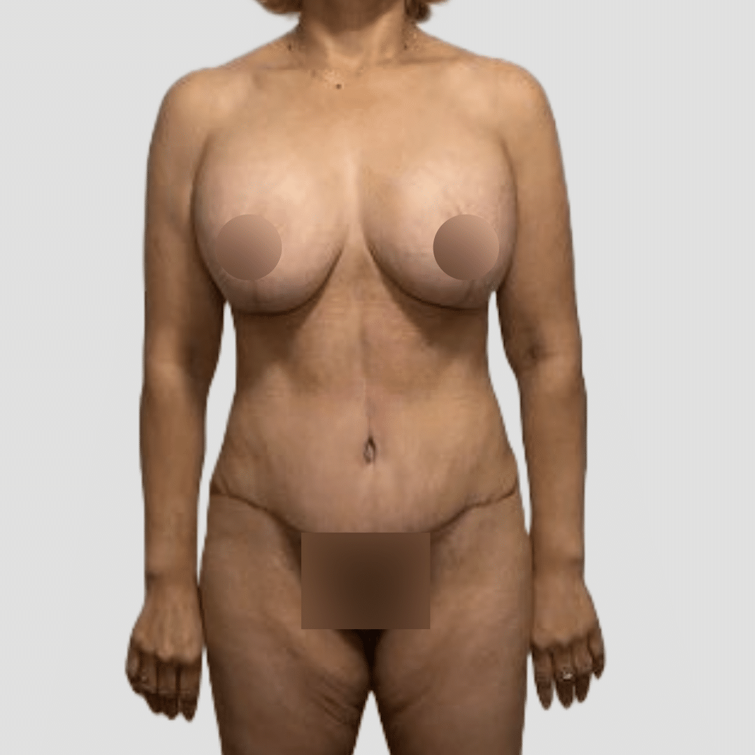 topless female patient after mommy makeover, stomach flatter and breasts lifted after procedure