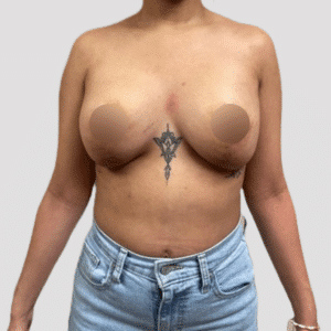 Breast Lift with Silicone Implants