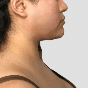 Submental Liposuction